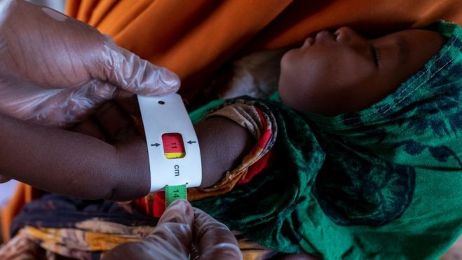 Revisión médica a un niño somalí de 7 meses desnutrido /Sebastian Rich para UNICEF